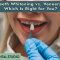 Teeth Whitening vs. Veneers: Which Is Right for You? (featured image)