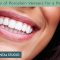 The Benefits of Porcelain Veneers for a Perfect Smile (featured image)